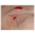 Hyfin® Vent Chest Wound Seal