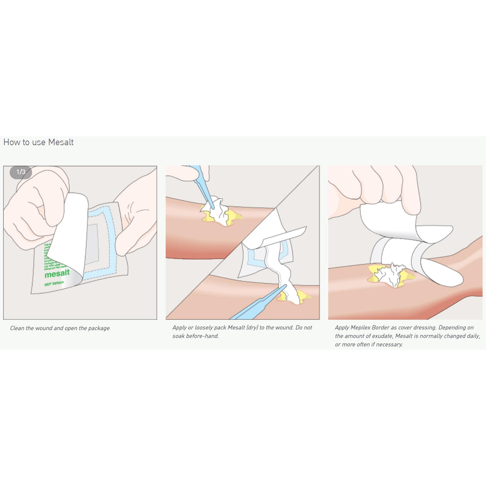 Mesalt® Sodium Chloride Impregnated Dressing Ribbon