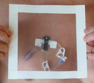 2G Medical Hydroseal Arm Cast Protector