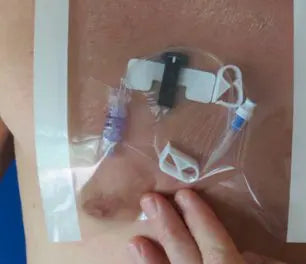 HydroSeal Wound Protector