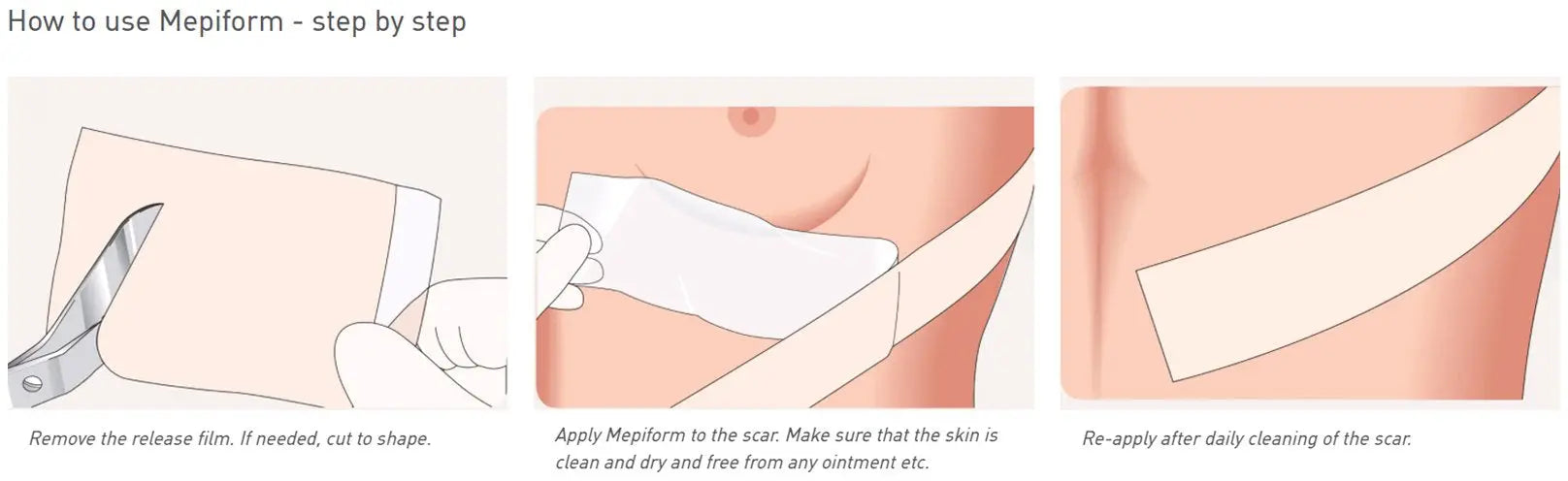 Mepiform Silicone Gel Sheeting with Safetac Technology