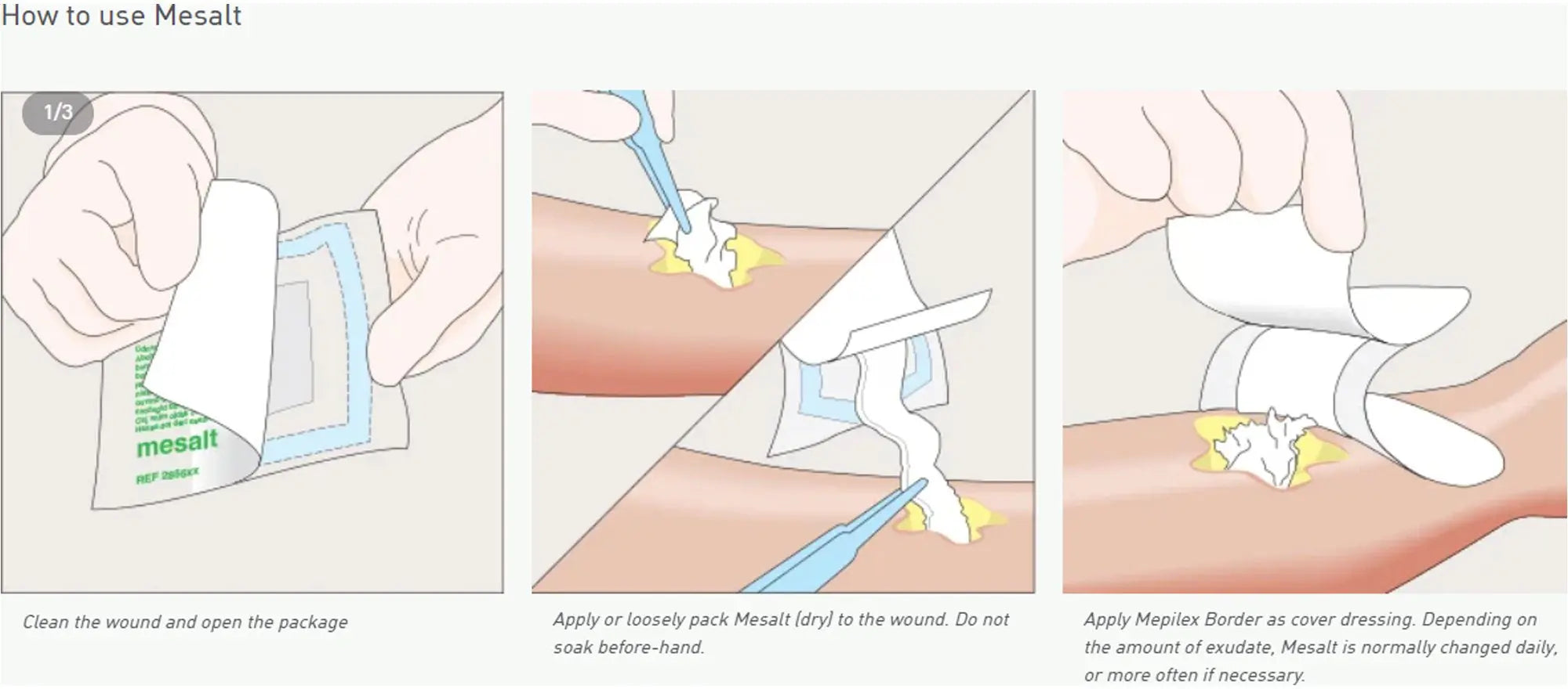 Mesalt Impregnated Dressing