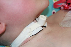MARPAC Collar-Holder Tracheostomy Tube Collar