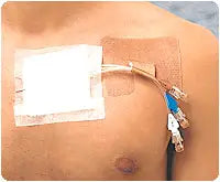 Gentell Cath-Strip Reclosable Catheter Fastener