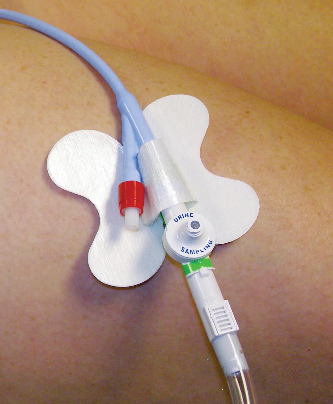 MC Johnson Co Inc Cath-Secure Plus Tube Holder — Hypoallergenic, Latex-Free