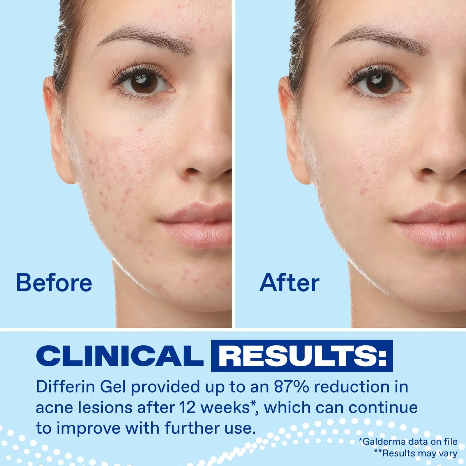 Differin Gel before and after clinical results showing up to 87 percent reduction in acne lesions after 12 weeks