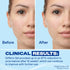 Differin Gel before and after clinical results showing up to 87 percent reduction in acne lesions after 12 weeks