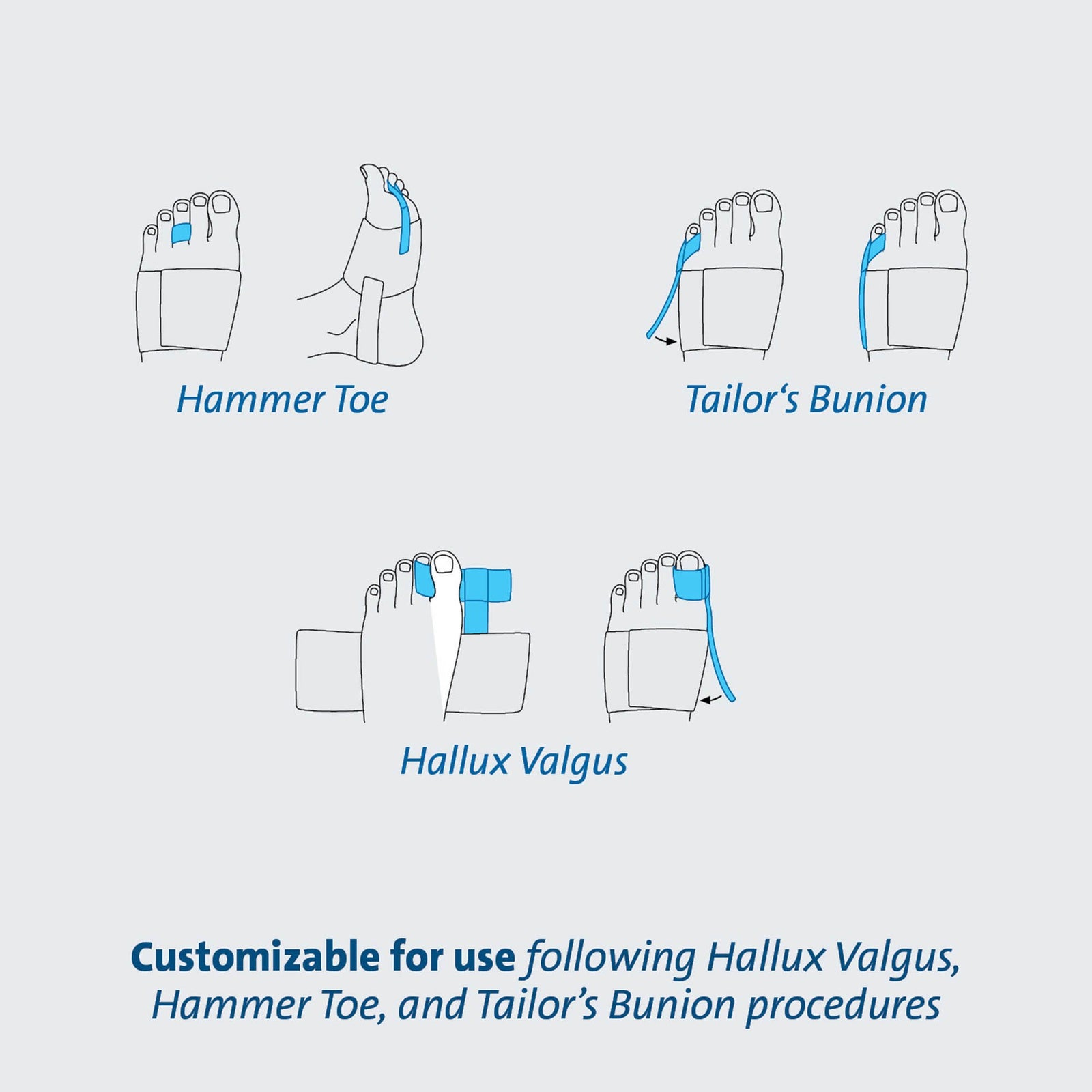 TAS Toe Splint