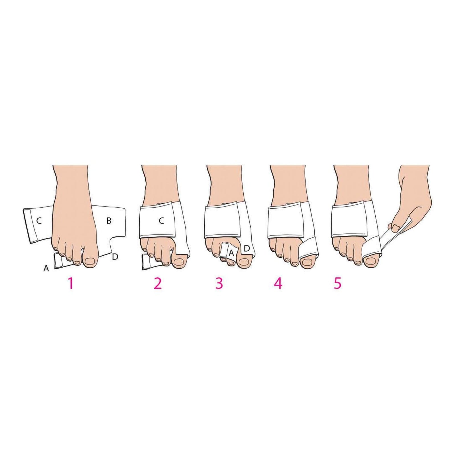 Softsplint Bunion Splint