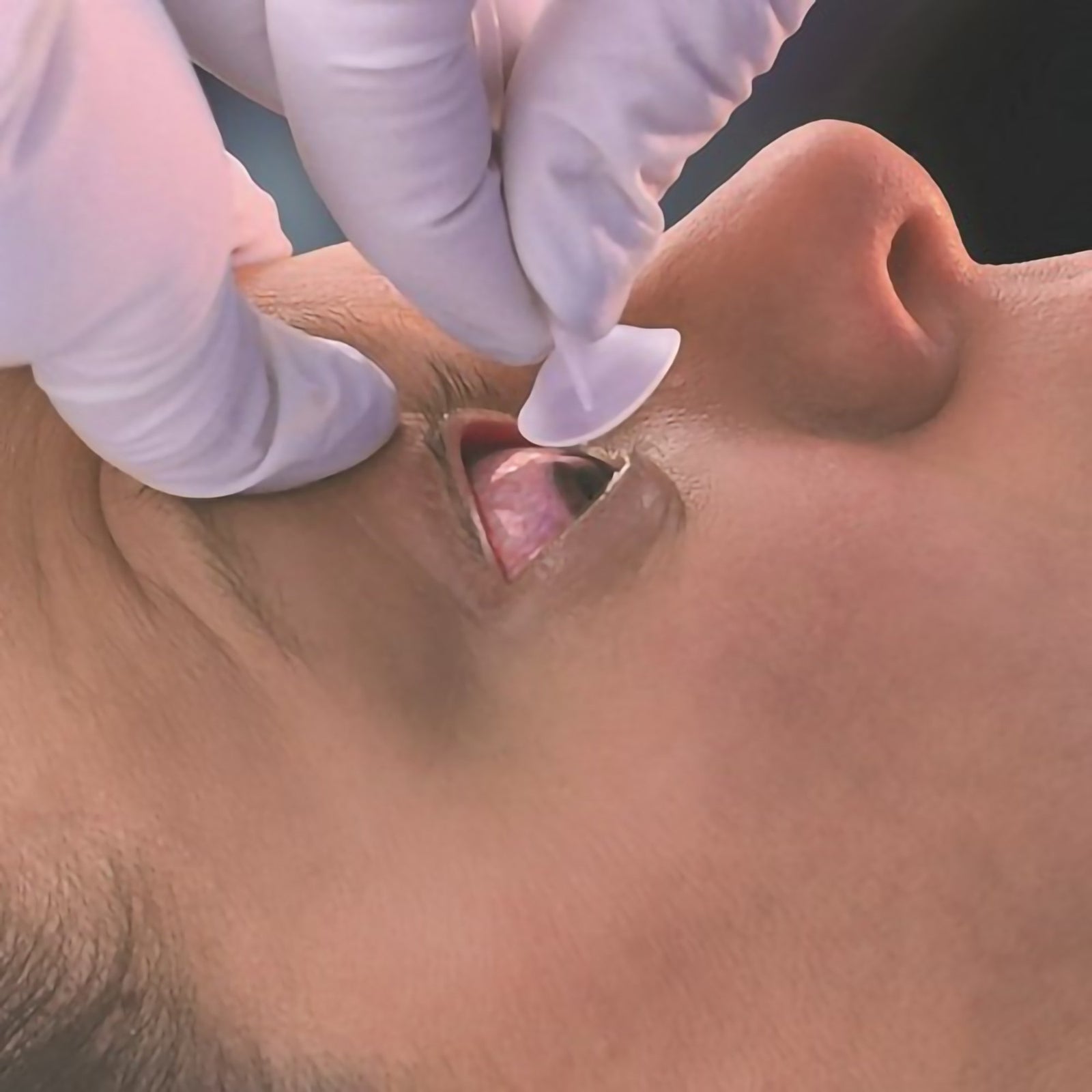 Morgan Lens Eye Irrigation System